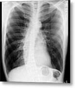 Chest X-ray - Copd And Scoliosis Metal Print