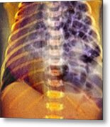 Congenital Diaphragmatic Hernia, X-ray Metal Print