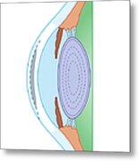 Cross Section Biomedical Illustration Of Human Eye Before Corrective Surgery For Myopia Metal Print