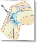Cross Section Biomedical Illustration Of Inside The Knee Joint During Rigid Endoscopy Procedure Metal Print