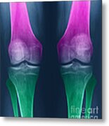 Osteoarthritis Of The Knees Metal Print