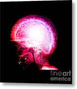 Pagets Disease Metal Print