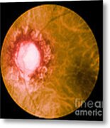 Retina Infected By Syphilis Metal Print