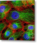 Breast Cancer Cells, Fm #6 Metal Print