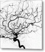Dural Arterial Venous Fistula, Angiogram Metal Print
