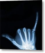 Hang Loose Metal Print