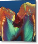 Polarised Lm Of A Molar Tooth Showing Decay Metal Print