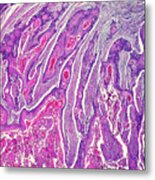 Carcinoma Of The Oesophagus #1 Metal Print