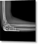 Fixed Elbow Fracture #2 Metal Print