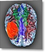 Glioblastoma Brain Cancer #2 Metal Print