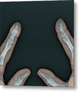 Psoriatic Arthritis, X-ray #3 Metal Print