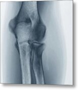 Normal Elbow Joint #7 Metal Print