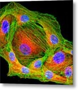 Cancer Cells Cytoskeleton And Nuclei Metal Print