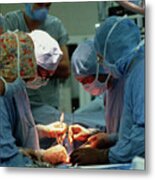 Doctors Performing Heart-lung Transplant Metal Print