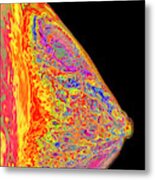 Fibrocystic Breast Disease Metal Print