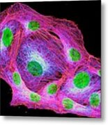 Osteosarcoma Cells Cytoskeleton And Nuclei Metal Print