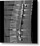 Spinal Fusion Surgery For Broken Back Metal Print