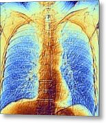 Ct Scan Of Chest Showing Heart And Lungs #1 Metal Print