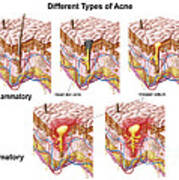 Different Types Of Acne #1 Poster