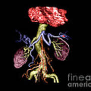 Splenic Artery Aneurysm #1 Poster