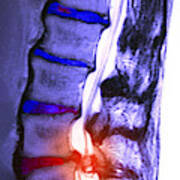 Arthritic Spine Poster