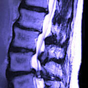 Arthritic Spine #3 Poster