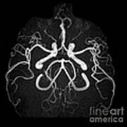 Normal Intracranial Mra #3 Poster