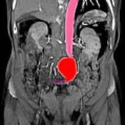 Ct Scan Of Abdominal Aortic Aneurysm #6 Poster