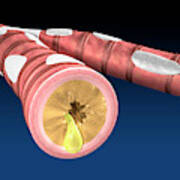 Acute Bronchitis Poster