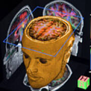 Advanced Mri Brain Scans Poster