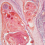 Anal Squamous Cell Carcinoma, Lm Poster