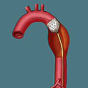 Aortic Stent Insertion, Illustration Poster