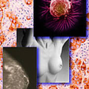 Breast Cancer Montage Poster
