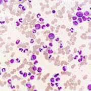 Chronic Granulocytic Leukemia Poster
