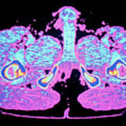 Coloured Computed Tomography Scan Of Erect Penis Poster