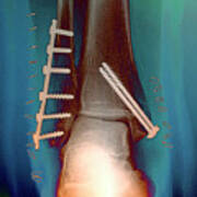 Pinned Ankle Fractures Poster
