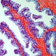 Prostate Cancer, Light Micrograph Poster