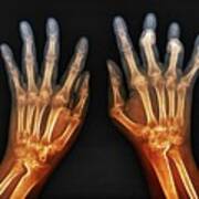 Rheumatoid Arthritis Of The Hands Poster