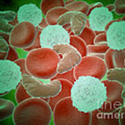 Sickle Cell Anemia With Red Blood Cells Poster