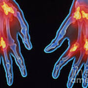 X-ray Of Arthritic Hands Poster