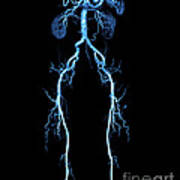 Ct Angiogram Of Abdomen And Legs #1 Poster