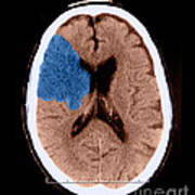 Ct Of Stroke #1 Poster