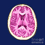 Normal Cross Sectional Mri Of The Brain #1 Poster