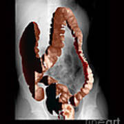 Normal Double Contrast Barium Enema #1 Poster