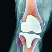 Knee Joint Prosthesis, X-ray #2 Poster