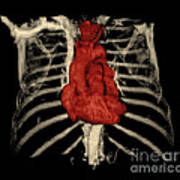 3d Ct Reconstruction Of Heart Poster