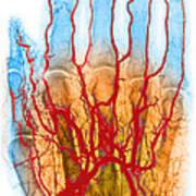 Hand Arteriogram #3 Poster