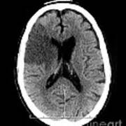 Ct Of Stroke #4 Poster