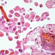 Asbestos In Lung Tissue, Light Micrograph Poster