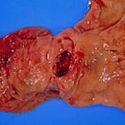 Bleeding Gastric Ulcer In Excised Part Of Stomach Poster